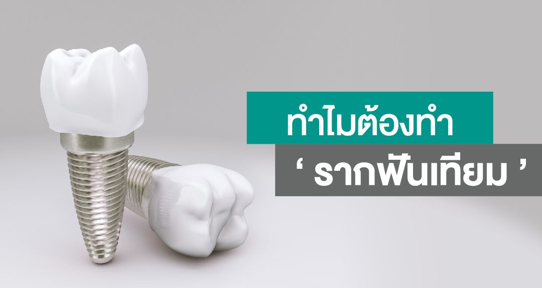 รากฟันเทียม (Implant)