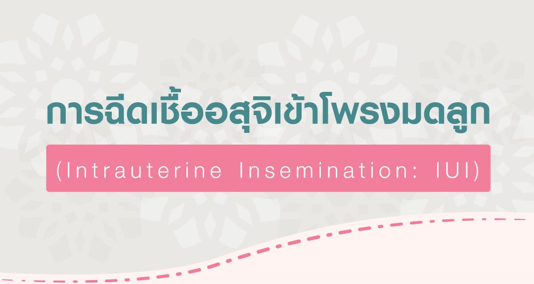 การฉีดเชื้ออสุจิเข้าโพรงมดลูก (Intrauterine Insemination: IUI)