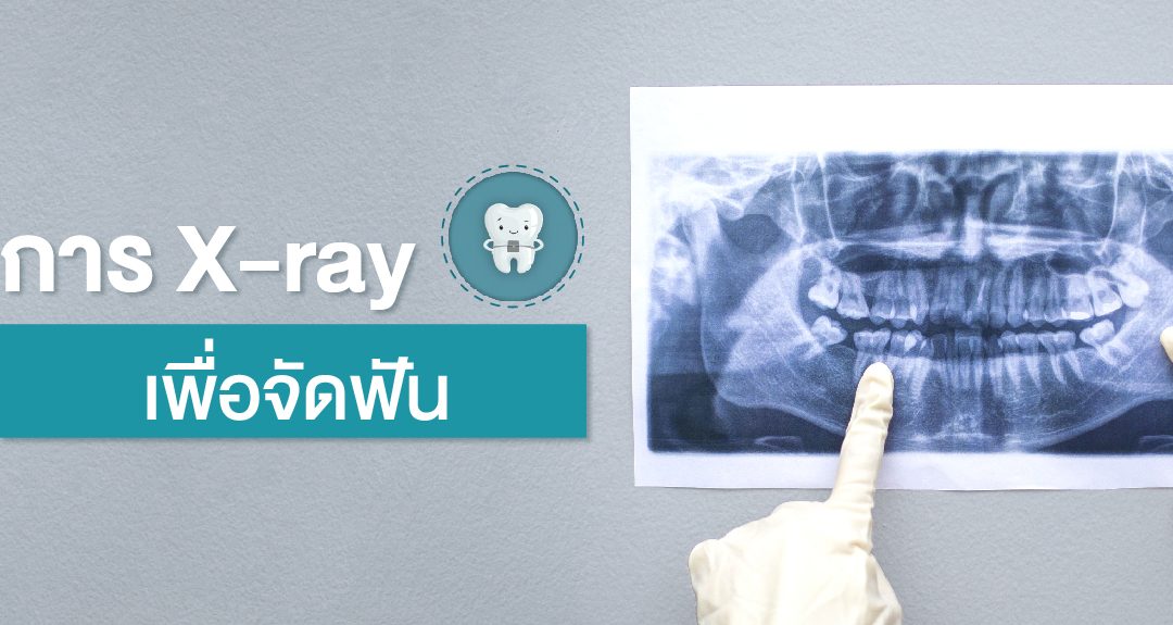 การ X-ray เพื่อจัดฟัน