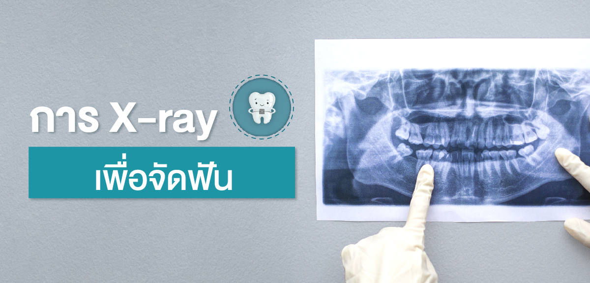 x ray เพื่อจัดหัน